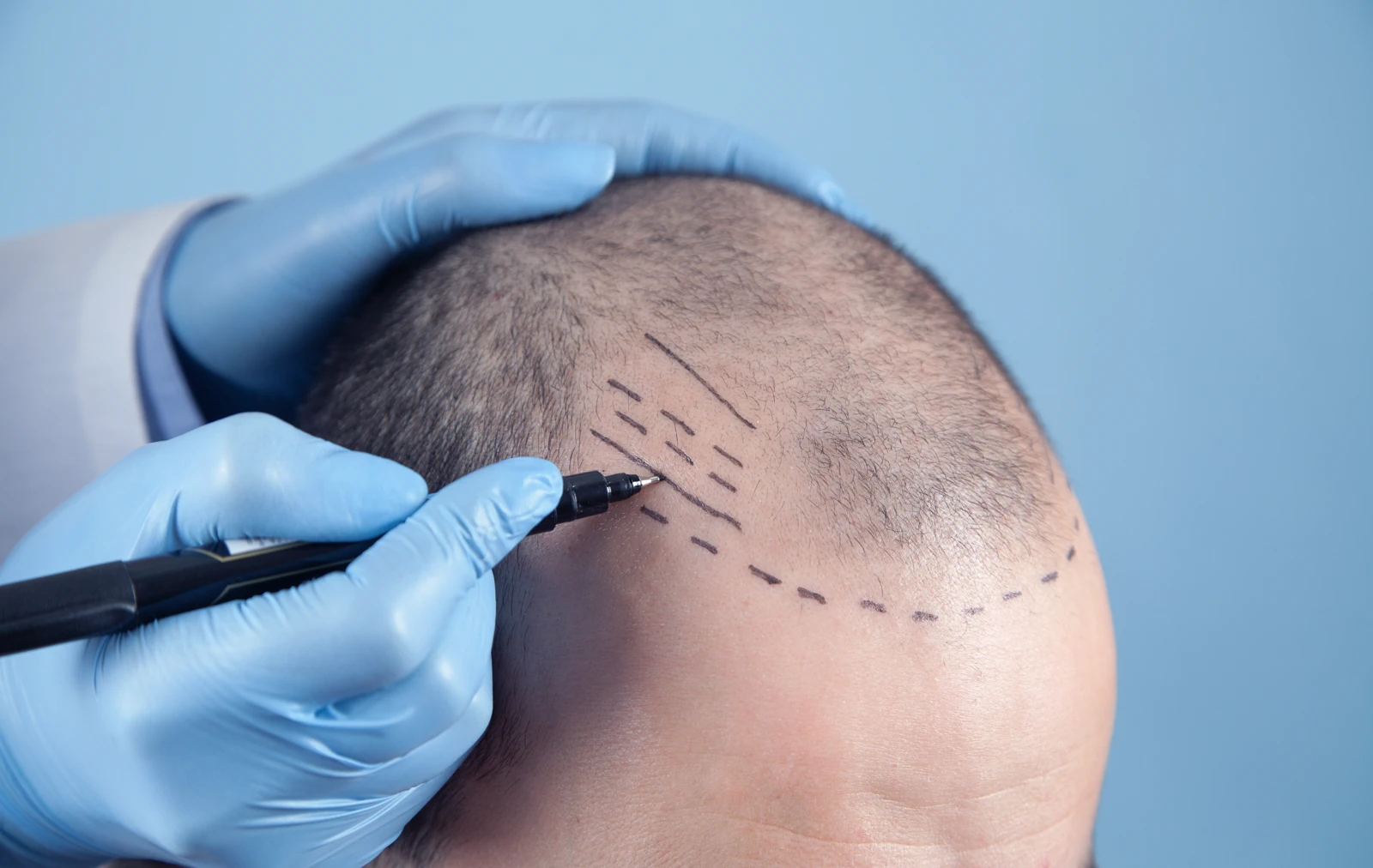 Hair transplant at Estecenter